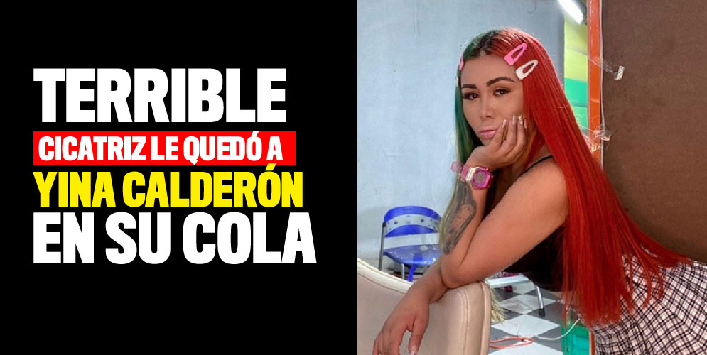 Terrible cicatriz le quedó a Yina Calderón en su cola
