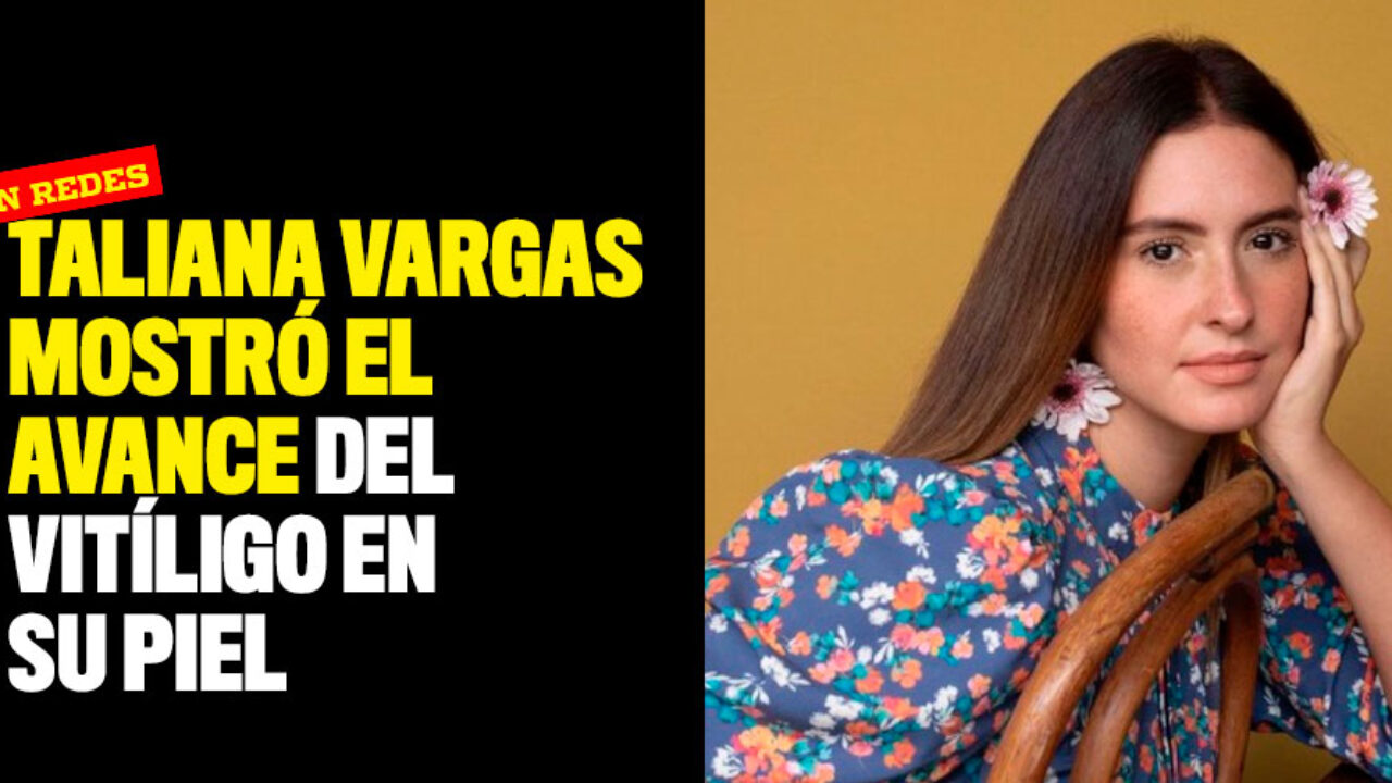 Taliana Vargas mostró el avance del vitíligo en su piel - Q'hubo Cali