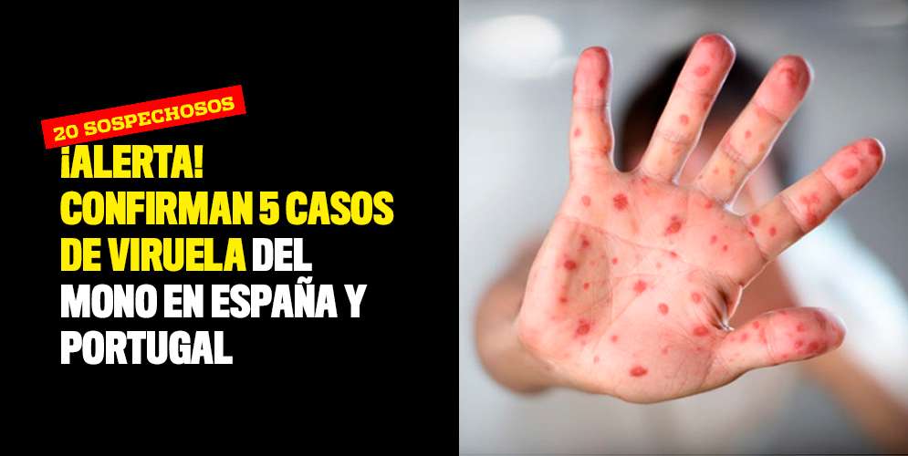 ¡Alerta! Confirman cinco casos de viruela del mono en España y Portugal