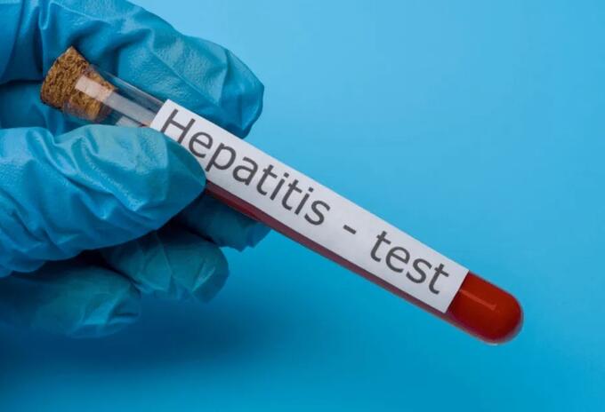 hepatitis 