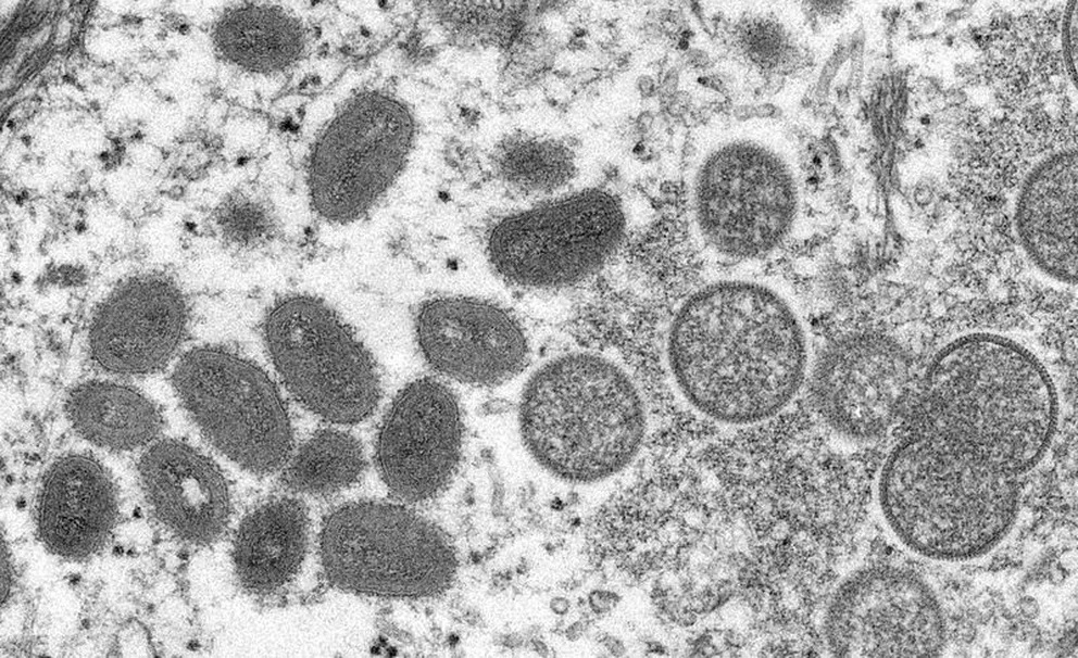 Confirman dos nuevos casos de viruela del mono en el país